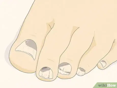 Image intitulée Know if You Have Neuropathy in Your Feet Step 4