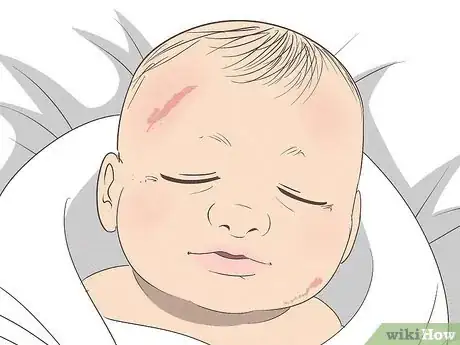 Image intitulée Know What to Expect on a Newborn's Skin Step 3