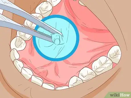 Image intitulée Unclog a Salivary Duct Step 13