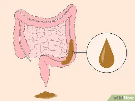Image intitulée Know If You Have Worms Step 10
