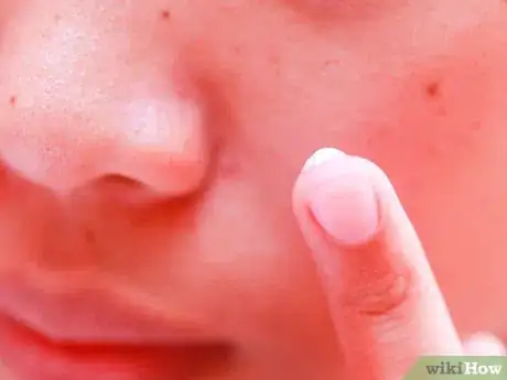 Image intitulée Make a Blackhead Remover (Epsom Salts and Iodine Method) Step 8