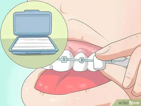 Image intitulée Make Your Braces Hurt Less Step 9