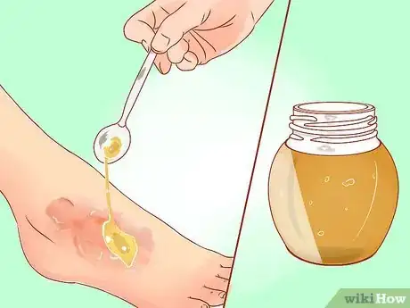 Image intitulée Treat a Burn Using Honey Step 5