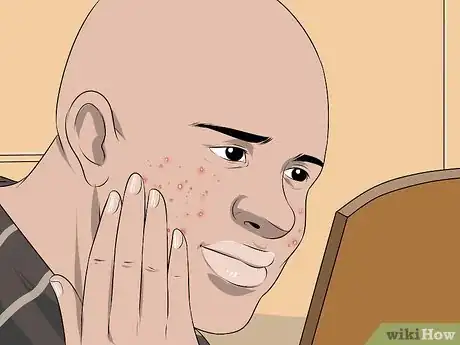 Image intitulée Dry Out a Pimple Step 18