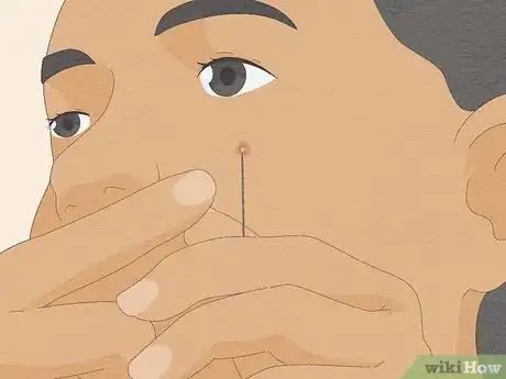 Image intitulée Pop a Pimple Step 12