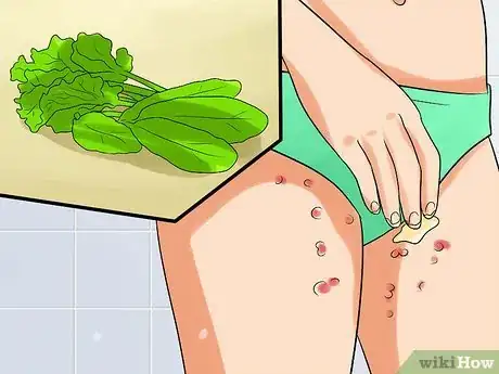 Image intitulée Ease Herpes Pain with Home Remedies Step 15