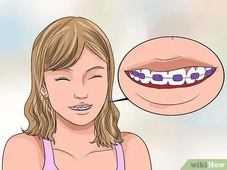 Image intitulée Choose the Color of Your Braces Step 6