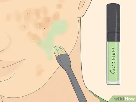 Image intitulée Get Rid of Cystic Acne Scars Step 17