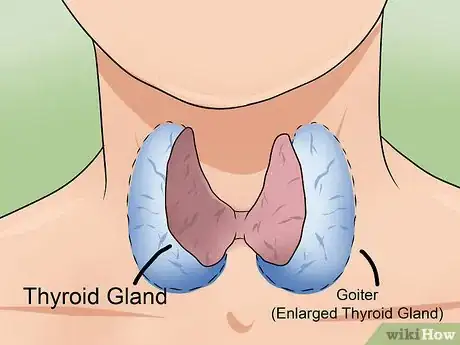 Image intitulée Heal Your Thyroid Naturally Step 17