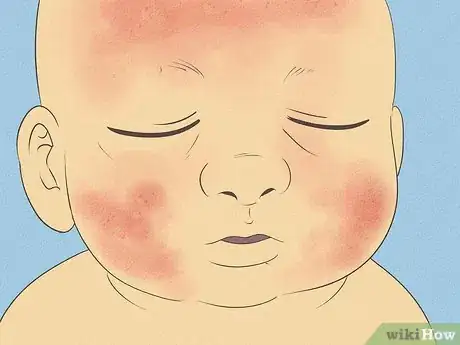 Image intitulée Know What to Expect on a Newborn's Skin Step 12