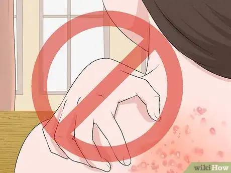 Image intitulée Get Rid of Poison Oak Rash Step 4