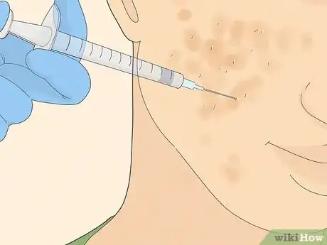 Image intitulée Get Rid of Cystic Acne Scars Step 12