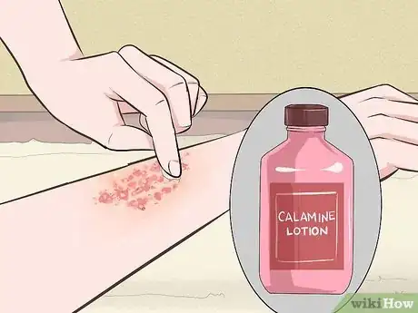 Image intitulée Get Rid of Poison Oak Rash Step 5