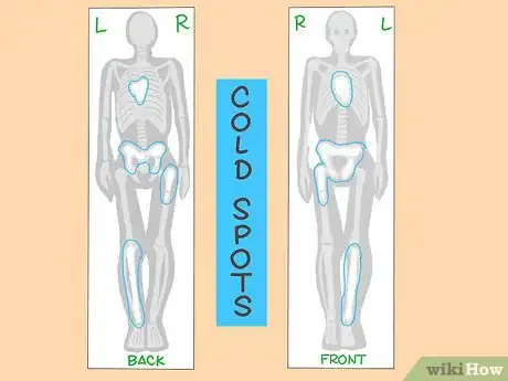 Image intitulée Understand the Results of a Bone Scan Step 6