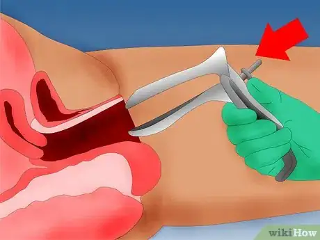 Image intitulée Do a Pap Smear Step 9