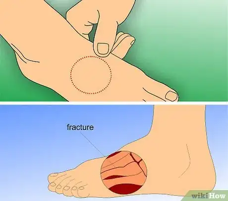 Image intitulée Treat a Foot Stress Fracture Step 1