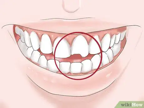 Image intitulée Know if Your Dental Fillings Need Replacing Step 9