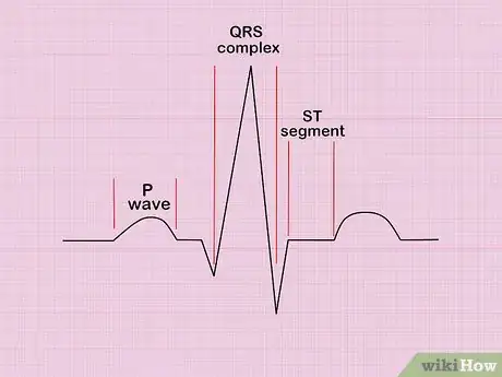 Image intitulée Calculate Heart Rate from ECG Step 1