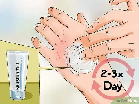 Image intitulée Reduce Eczema Itching Step 7