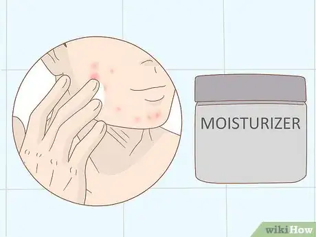 Image intitulée Take Care of Your Skin While on Accutane Step 5