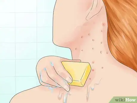 Image intitulée Treat Folliculitis Step 1