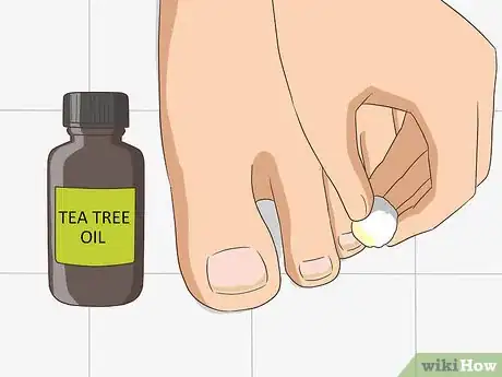 Image intitulée Treat Toe Nail Fungus Step 6