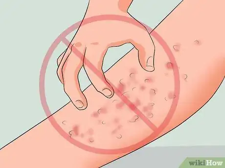 Image intitulée Get Rid of a Rash from Nair Step 8