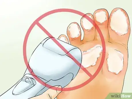 Image intitulée Remove Calluses Naturally Step 13