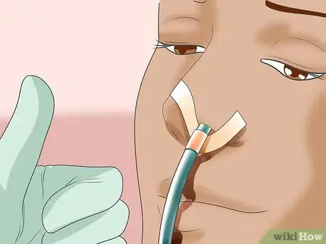 Image intitulée Insert a Nasogastric (NG) Tube Step 15