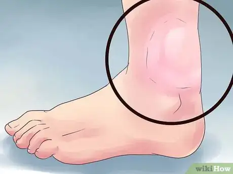 Image intitulée Know if You Have Cirrhosis Step 8