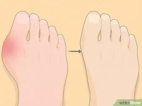 Image intitulée Treat Gout Step 2