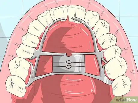 Image intitulée Straighten Your Teeth Without Braces Step 13