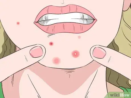 Image intitulée Recognize Staph Infection Symptoms Step 1