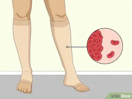 Image intitulée Clear Blood Clots Naturally Step 7