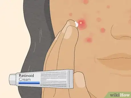 Image intitulée Get Rid of Cystic Acne Scars Step 22