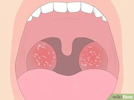 Image intitulée Tell if You Have Strep Throat Step 7