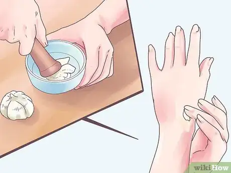 Image intitulée Treat Embarrassing Water Warts Step 10