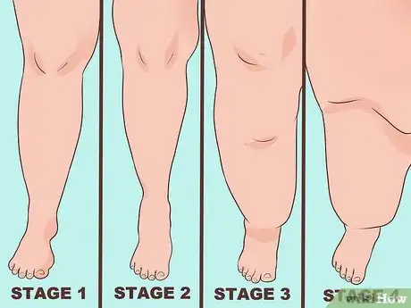 Image intitulée Diagnose Lipedema Step 2