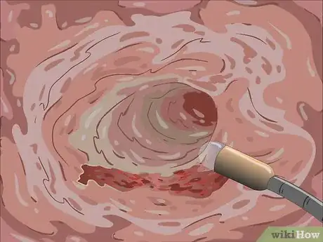 Image intitulée Treat a Bleeding Ulcer Step 10