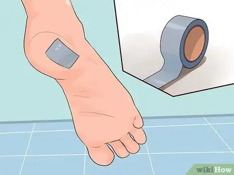 Image intitulée Get Rid of a Wart at the Bottom of Your Foot Step 4