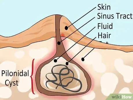 Image intitulée Treat a Pilonidal Cyst Step 10