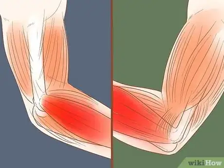 Image intitulée Heal a Sore Arm Step 2