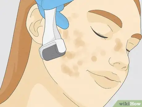 Image intitulée Get Rid of Cystic Acne Scars Step 15