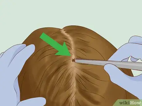 Image intitulée Get Rid of Ticks in Your Hair Step 1