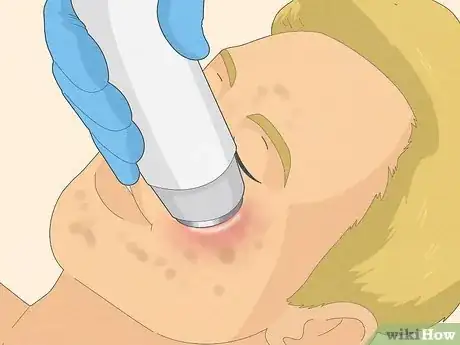 Image intitulée Get Rid of Cystic Acne Scars Step 13