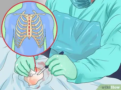 Image intitulée Remove a Thymoma Step 5