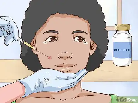 Image intitulée Painlessly Pop a Pimple Step 12