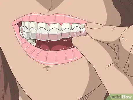 Image intitulée Straighten Your Teeth Without Braces Step 11