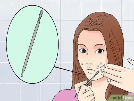 Image intitulée Decrease the Size of a Pimple Overnight Step 7