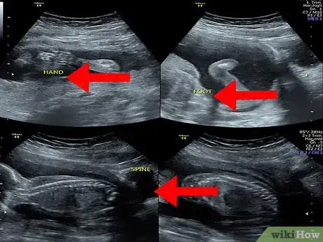 Image intitulée Read an Ultrasound Picture Step 6